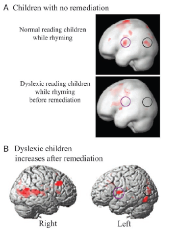 Dyslexic children increases after remediation