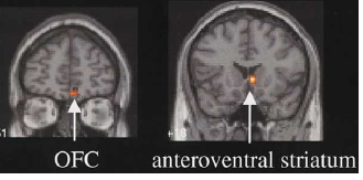 Orbitofrontal cortex and anteroventral striatum