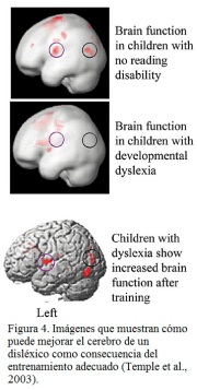 Cerebro disléxico mejorado